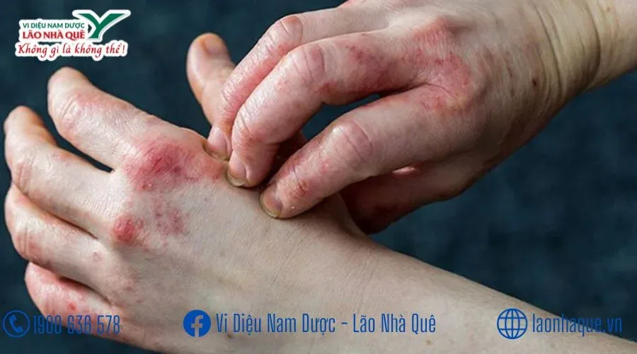 BỆNH THƯỢNG BÌ BỌNG NƯỚC