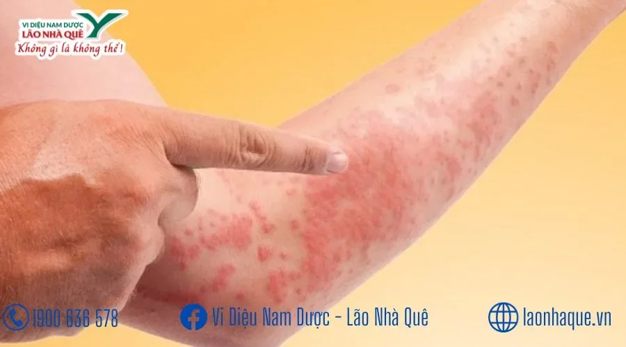 CÁC BỆNH VỀ DA ĐÔNG TÂY Y ĐẦU HÀNG
