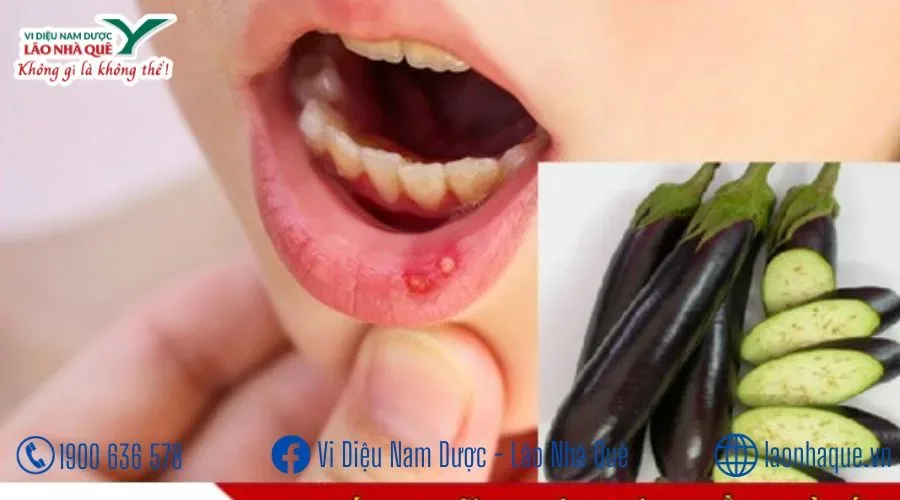 CÁCH TRỊ NHIỆT MIỆNG HIỆU QUẢ