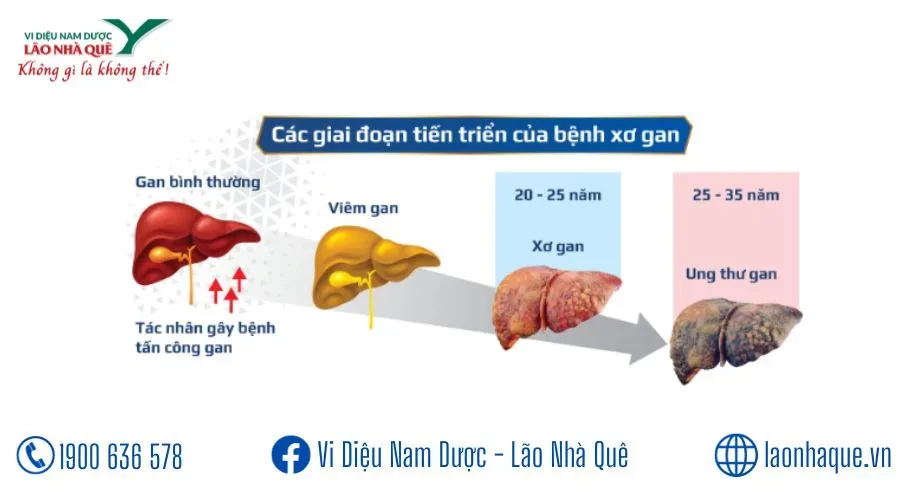 CAO BÁCH HỢP VÀ CÁC BỆNH GÚT, XƠ GAN CỔ CHƯỚNG, VIÊM GAN B GAN C