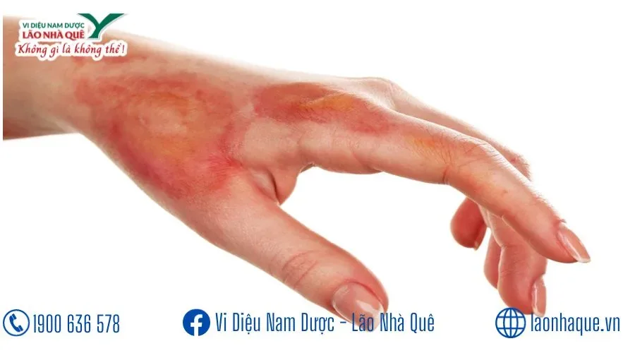 CHỮA BỎNG SIÊU HIỆU NGHIỆM