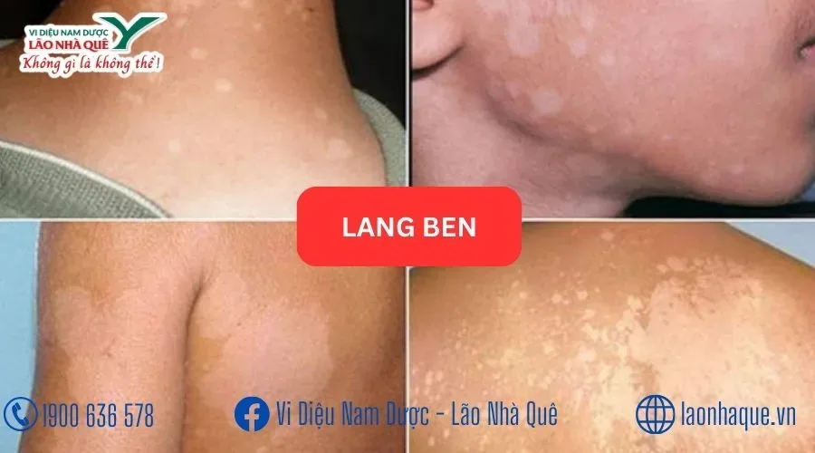 CHỮA LANG BEN