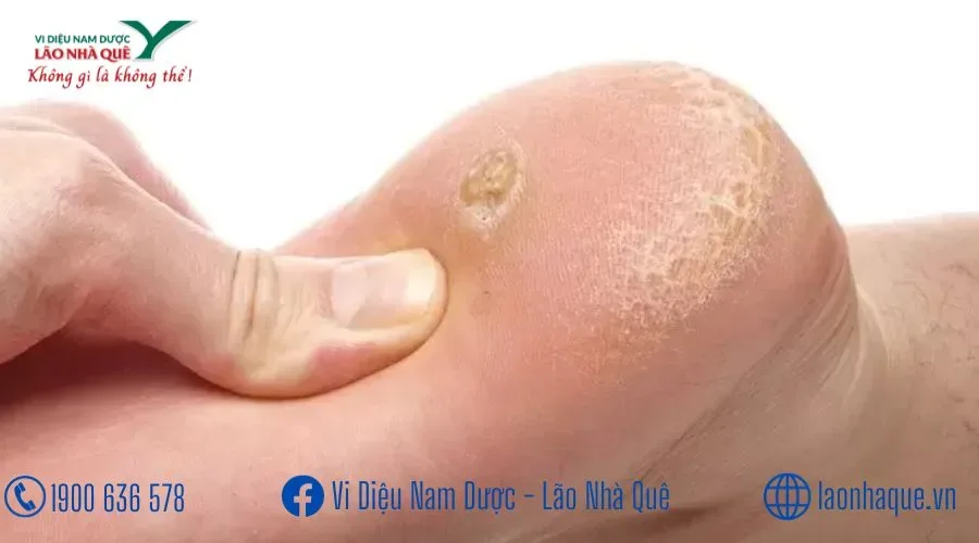 CHỮA MỤN CƠM, NỐT CHAI CỤC DƯỚI BÀN CHÂN