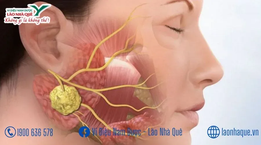 Chữa bệnh quai bị