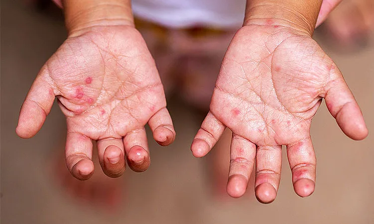 DỊCH CHÂN TAY MIỆNG TRẺ EM