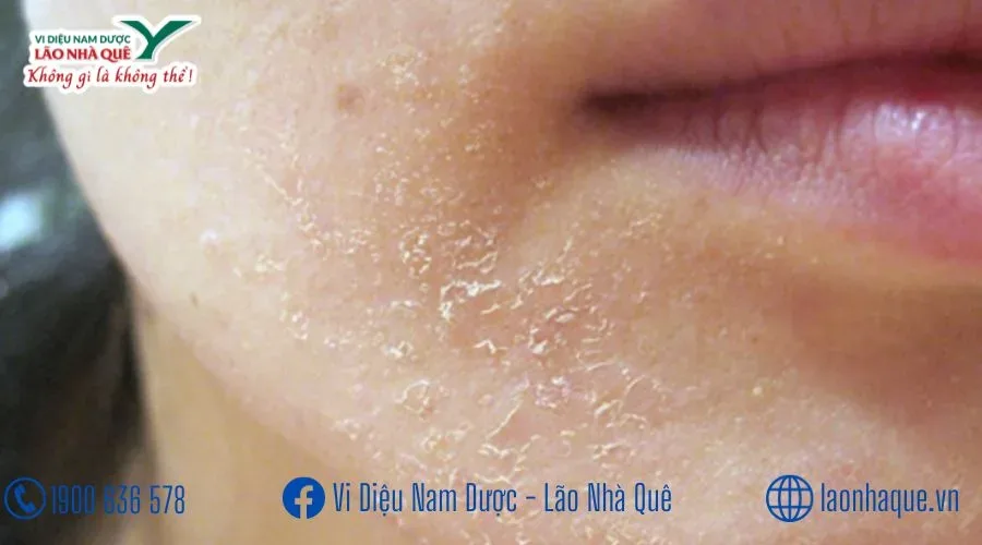 KHÔNG KHÔ NẺ KHÔNG MẨN NGỨA