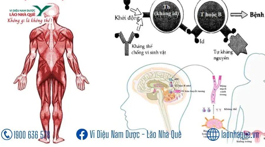 LUPUS BAN ĐỎ, BỆNH VẨY NẾN