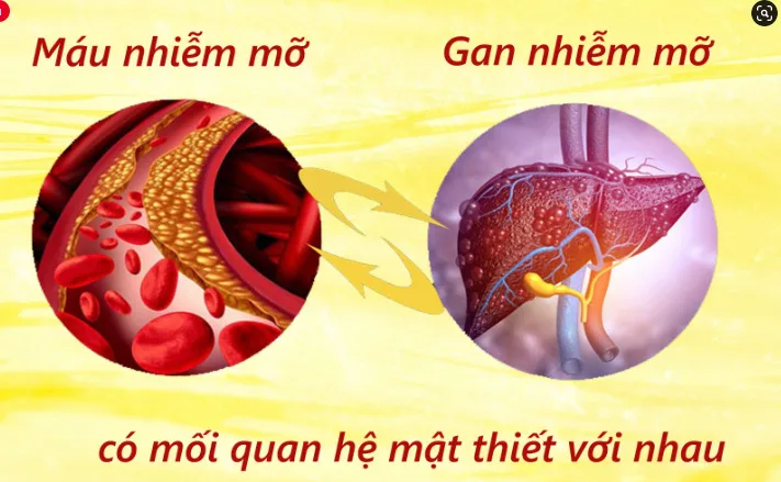 MỠ MÁU, GAN NHIỄM MỠ, MEN GAN CAO TẨY SẠCH THÀNH MẠCH