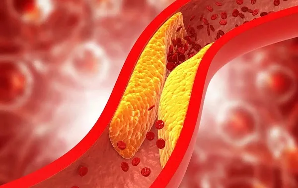 Máu đông Xơ Vữa mạch Máu