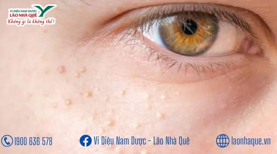 NÁM MẶT MỤN THỊT TRÊN MẮT VÀ MẶT