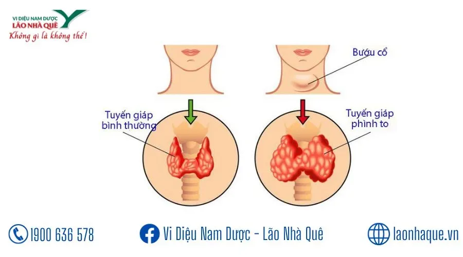 U TUYẾN GIÁP, BƯỚU CỔ, BASEDOW
