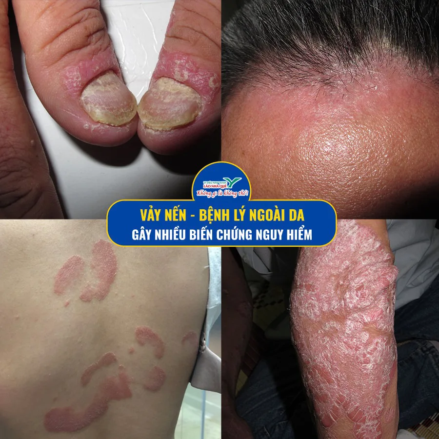 Chữa bệnh vẩy nến