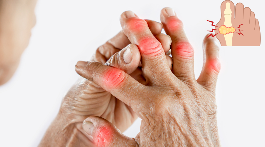 CHỮA BỆNH GOUT
