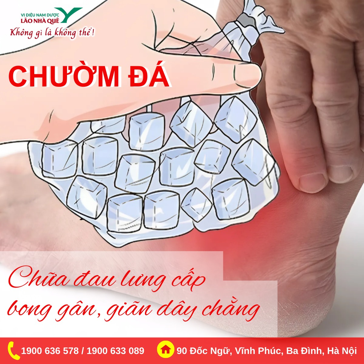 CHƯỜM ĐÁ CHỮA ĐAU LƯNG CẤP, BONG GÂN, GIÃN DÂY CHẰNG
