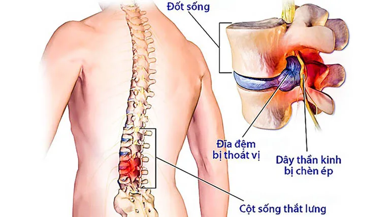 Chuyện thoát vị đĩa đệm