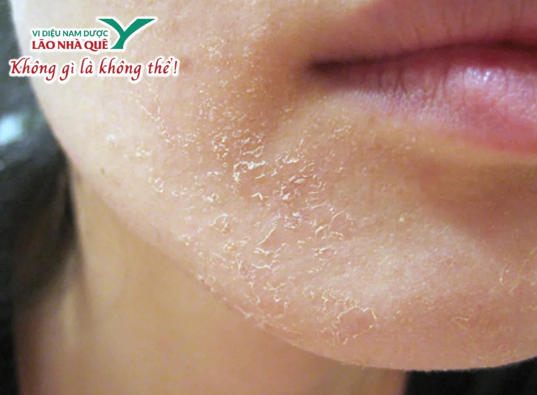 Chữa nẻ – mẩn ngứa – hay bị mụn nhọt