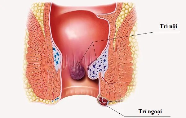 TRĨ NỘI – TRĨ NGOẠI