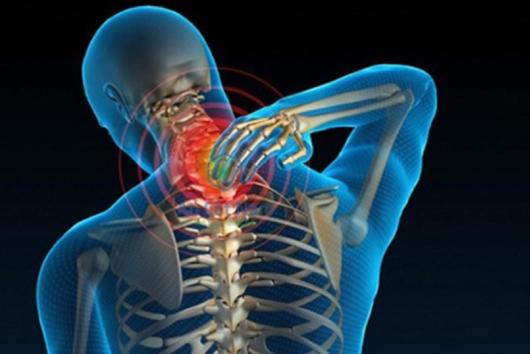 Vôi hóa đốt sống cổ, nhức mỏi, đau vai, tê bì hai tay